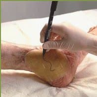 Comfeel Plus Ulcer Dressing Sterile 6"X6" Hydrocolloid Dressing - Model 3115 by Coloplast